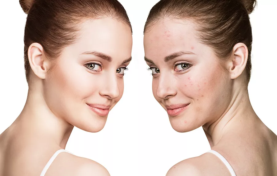 Acne: alcuni suggerimenti